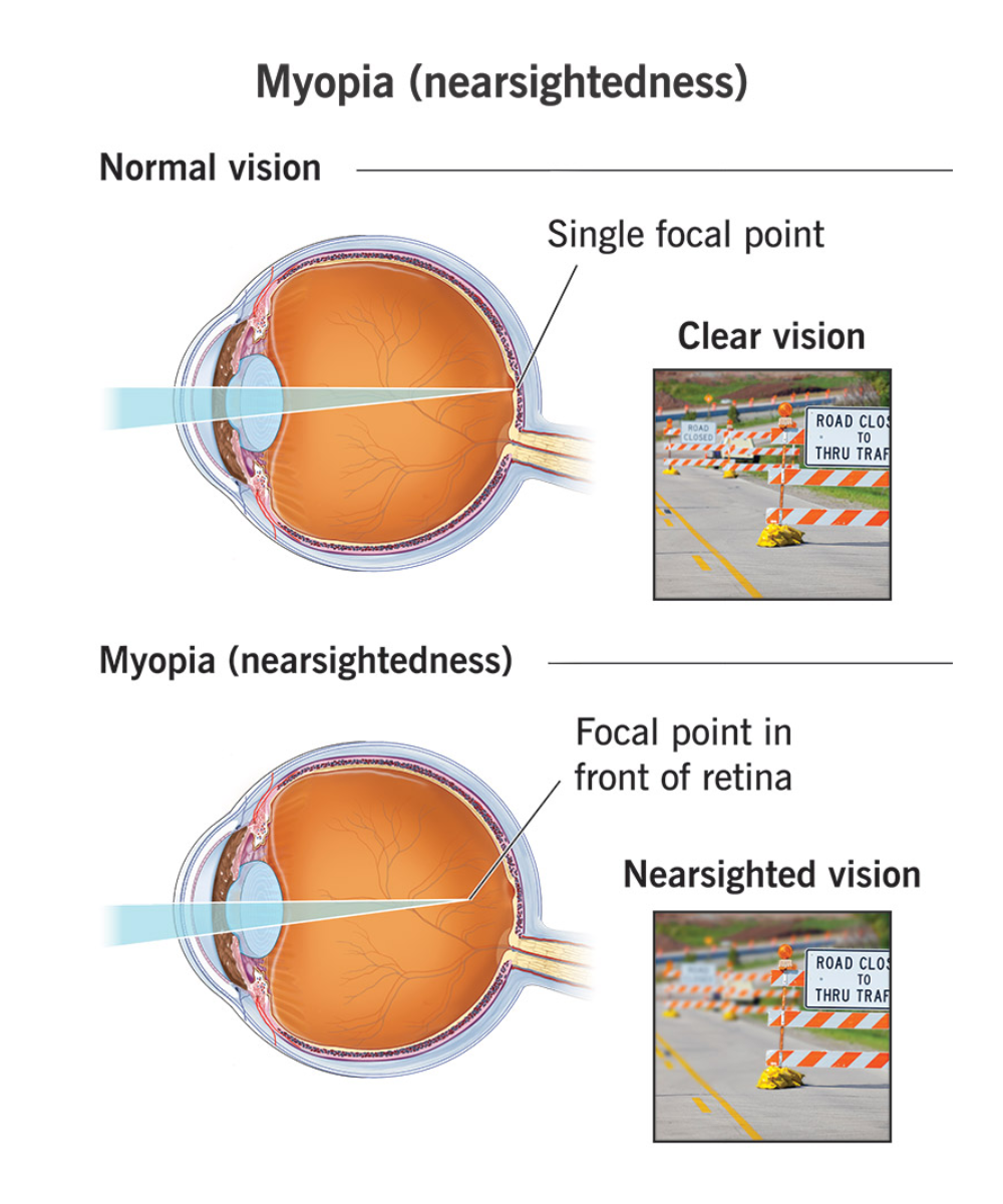 {"type":"elementor","siteurl":"https://eye.globdigi.com/wp-json/","elements":[{"id":"c619587","elType":"widget","isInner":false,"isLocked":false,"settings":{"image":{"url":"","id":"","size":"","alt":"","source":"library"},"image_size":"large","image_custom_dimension":{"width":"","height":""},"caption_source":"none","caption":"","link_to":"none","link":{"url":"","is_external":"","nofollow":"","custom_attributes":""},"open_lightbox":"default","align":"","align_tablet":"","align_mobile":"","width":{"unit":"%","size":"","sizes":[]},"width_tablet":{"unit":"%","size":"","sizes":[]},"width_mobile":{"unit":"%","size":"","sizes":[]},"space":{"unit":"%","size":"","sizes":[]},"space_tablet":{"unit":"%","size":"","sizes":[]},"space_mobile":{"unit":"%","size":"","sizes":[]},"height":{"unit":"px","size":"","sizes":[]},"height_tablet":{"unit":"px","size":"","sizes":[]},"height_mobile":{"unit":"px","size":"","sizes":[]},"object-fit":"","object-fit_tablet":"","object-fit_mobile":"","object-position":"center center","object-position_tablet":"","object-position_mobile":"","opacity":{"unit":"px","size":"","sizes":[]},"css_filters_css_filter":"","css_filters_blur":{"unit":"px","size":0,"sizes":[]},"css_filters_brightness":{"unit":"px","size":100,"sizes":[]},"css_filters_contrast":{"unit":"px","size":100,"sizes":[]},"css_filters_saturate":{"unit":"px","size":100,"sizes":[]},"css_filters_hue":{"unit":"px","size":0,"sizes":[]},"opacity_hover":{"unit":"px","size":"","sizes":[]},"css_filters_hover_css_filter":"","css_filters_hover_blur":{"unit":"px","size":0,"sizes":[]},"css_filters_hover_brightness":{"unit":"px","size":100,"sizes":[]},"css_filters_hover_contrast":{"unit":"px","size":100,"sizes":[]},"css_filters_hover_saturate":{"unit":"px","size":100,"sizes":[]},"css_filters_hover_hue":{"unit":"px","size":0,"sizes":[]},"background_hover_transition":{"unit":"px","size":"","sizes":[]},"hover_animation":"","image_border_border":"","image_border_width":{"unit":"px","top":"","right":"","bottom":"","left":"","isLinked":true},"image_border_width_tablet":{"unit":"px","top":"","right":"","bottom":"","left":"","isLinked":true},"image_border_width_mobile":{"unit":"px","top":"","right":"","bottom":"","left":"","isLinked":true},"image_border_color":"","image_border_radius":{"unit":"px","top":"","right":"","bottom":"","left":"","isLinked":true},"image_border_radius_tablet":{"unit":"px","top":"","right":"","bottom":"","left":"","isLinked":true},"image_border_radius_mobile":{"unit":"px","top":"","right":"","bottom":"","left":"","isLinked":true},"image_box_shadow_box_shadow_type":"","image_box_shadow_box_shadow":{"horizontal":0,"vertical":0,"blur":10,"spread":0,"color":"rgba(0,0,0,0.5)"},"caption_align":"","caption_align_tablet":"","caption_align_mobile":"","text_color":"","caption_background_color":"","caption_typography_typography":"","caption_typography_font_family":"","caption_typography_font_size":{"unit":"px","size":"","sizes":[]},"caption_typography_font_size_tablet":{"unit":"px","size":"","sizes":[]},"caption_typography_font_size_mobile":{"unit":"px","size":"","sizes":[]},"caption_typography_font_weight":"","caption_typography_text_transform":"","caption_typography_font_style":"","caption_typography_text_decoration":"","caption_typography_line_height":{"unit":"px","size":"","sizes":[]},"caption_typography_line_height_tablet":{"unit":"em","size":"","sizes":[]},"caption_typography_line_height_mobile":{"unit":"em","size":"","sizes":[]},"caption_typography_letter_spacing":{"unit":"px","size":"","sizes":[]},"caption_typography_letter_spacing_tablet":{"unit":"px","size":"","sizes":[]},"caption_typography_letter_spacing_mobile":{"unit":"px","size":"","sizes":[]},"caption_typography_word_spacing":{"unit":"px","size":"","sizes":[]},"caption_typography_word_spacing_tablet":{"unit":"em","size":"","sizes":[]},"caption_typography_word_spacing_mobile":{"unit":"em","size":"","sizes":[]},"caption_text_shadow_text_shadow_type":"","caption_text_shadow_text_shadow":{"horizontal":0,"vertical":0,"blur":10,"color":"rgba(0,0,0,0.3)"},"caption_space":{"unit":"px","size":"","sizes":[]},"caption_space_tablet":{"unit":"px","size":"","sizes":[]},"caption_space_mobile":{"unit":"px","size":"","sizes":[]},"_title":"","_margin":{"unit":"px","top":"","right":"","bottom":"","left":"","isLinked":true},"_margin_tablet":{"unit":"px","top":"","right":"","bottom":"","left":"","isLinked":true},"_margin_mobile":{"unit":"px","top":"","right":"","bottom":"","left":"","isLinked":true},"_padding":{"unit":"px","top":"","right":"","bottom":"","left":"","isLinked":true},"_padding_tablet":{"unit":"px","top":"","right":"","bottom":"","left":"","isLinked":true},"_padding_mobile":{"unit":"px","top":"","right":"","bottom":"","left":"","isLinked":true},"_element_width":"","_element_width_tablet":"","_element_width_mobile":"","_element_custom_width":{"unit":"%","size":"","sizes":[]},"_element_custom_width_tablet":{"unit":"px","size":"","sizes":[]},"_element_custom_width_mobile":{"unit":"px","size":"","sizes":[]},"_grid_column":"","_grid_column_tablet":"","_grid_column_mobile":"","_grid_column_custom":"","_grid_column_custom_tablet":"","_grid_column_custom_mobile":"","_grid_row":"","_grid_row_tablet":"","_grid_row_mobile":"","_grid_row_custom":"","_grid_row_custom_tablet":"","_grid_row_custom_mobile":"","_flex_align_self":"","_flex_align_self_tablet":"","_flex_align_self_mobile":"","_flex_order":"","_flex_order_tablet":"","_flex_order_mobile":"","_flex_order_custom":"","_flex_order_custom_tablet":"","_flex_order_custom_mobile":"","_flex_size":"","_flex_size_tablet":"","_flex_size_mobile":"","_flex_grow":1,"_flex_grow_tablet":"","_flex_grow_mobile":"","_flex_shrink":1,"_flex_shrink_tablet":"","_flex_shrink_mobile":"","_element_vertical_align":"","_element_vertical_align_tablet":"","_element_vertical_align_mobile":"","_position":"","_offset_orientation_h":"start","_offset_x":{"unit":"px","size":0,"sizes":[]},"_offset_x_tablet":{"unit":"px","size":"","sizes":[]},"_offset_x_mobile":{"unit":"px","size":"","sizes":[]},"_offset_x_end":{"unit":"px","size":0,"sizes":[]},"_offset_x_end_tablet":{"unit":"px","size":"","sizes":[]},"_offset_x_end_mobile":{"unit":"px","size":"","sizes":[]},"_offset_orientation_v":"start","_offset_y":{"unit":"px","size":0,"sizes":[]},"_offset_y_tablet":{"unit":"px","size":"","sizes":[]},"_offset_y_mobile":{"unit":"px","size":"","sizes":[]},"_offset_y_end":{"unit":"px","size":0,"sizes":[]},"_offset_y_end_tablet":{"unit":"px","size":"","sizes":[]},"_offset_y_end_mobile":{"unit":"px","size":"","sizes":[]},"_z_index":"","_z_index_tablet":"","_z_index_mobile":"","_element_id":"","_css_classes":"","_element_cache":"","eael_wrapper_link_switch":"","eael_wrapper_link":{"url":"","is_external":"","nofollow":"","custom_attributes":""},"eael_wrapper_link_disable_traditional":"","eael_hover_effect_switch":"","eael_hover_effect_enable_live_changes":"","eael_hover_effect_opacity_popover":"","eael_hover_effect_opacity":{"unit":"px","size":0.8,"sizes":[]},"eael_hover_effect_filter_popover":"","eael_hover_effect_blur_is_on":"","eael_hover_effect_blur":{"unit":"px","size":1,"sizes":[]},"eael_hover_effect_contrast_is_on":"","eael_hover_effect_contrast":{"unit":"px","size":80,"sizes":[]},"eael_hover_effect_grayscale_is_on":"","eael_hover_effect_grayscal":{"unit":"px","size":40,"sizes":[]},"eael_hover_effect_invert_is_on":"","eael_hover_effect_invert":{"unit":"px","size":70,"sizes":[]},"eael_hover_effect_saturate_is_on":"","eael_hover_effect_saturate":{"unit":"px","size":50,"sizes":[]},"eael_hover_effect_sepia_is_on":"","eael_hover_effect_sepia":{"unit":"px","size":50,"sizes":[]},"eael_hover_effect_offset_popover":"","eael_hover_effect_offset_left":{"unit":"px","size":5,"sizes":[]},"eael_hover_effect_offset_left_tablet":{"unit":"px","size":"","sizes":[]},"eael_hover_effect_offset_left_mobile":{"unit":"px","size":"","sizes":[]},"eael_hover_effect_offset_top":{"unit":"px","size":5,"sizes":[]},"eael_hover_effect_offset_top_tablet":{"unit":"px","size":"","sizes":[]},"eael_hover_effect_offset_top_mobile":{"unit":"px","size":"","sizes":[]},"eael_hover_effect_transform_popover":"","eael_hover_effect_rotate_is_on":"","eael_hover_effect_transform_rotatex":{"unit":"px","size":0,"sizes":[]},"eael_hover_effect_transform_rotatex_tablet":{"unit":"px","size":"","sizes":[]},"eael_hover_effect_transform_rotatex_mobile":{"unit":"px","size":"","sizes":[]},"eael_hover_effect_transform_rotatey":{"unit":"px","size":0,"sizes":[]},"eael_hover_effect_transform_rotatey_tablet":{"unit":"px","size":"","sizes":[]},"eael_hover_effect_transform_rotatey_mobile":{"unit":"px","size":"","sizes":[]},"eael_hover_effect_transform_rotatez":{"unit":"px","size":5,"sizes":[]},"eael_hover_effect_transform_rotatez_tablet":{"unit":"px","size":"","sizes":[]},"eael_hover_effect_transform_rotatez_mobile":{"unit":"px","size":"","sizes":[]},"eael_hover_effect_scale_is_on":"","eael_hover_effect_transform_scalex":{"unit":"px","size":0.9,"sizes":[]},"eael_hover_effect_transform_scalex_tablet":{"unit":"px","size":"","sizes":[]},"eael_hover_effect_transform_scalex_mobile":{"unit":"px","size":"","sizes":[]},"eael_hover_effect_transform_scaley":{"unit":"px","size":0.9,"sizes":[]},"eael_hover_effect_transform_scaley_tablet":{"unit":"px","size":"","sizes":[]},"eael_hover_effect_transform_scaley_mobile":{"unit":"px","size":"","sizes":[]},"eael_hover_effect_skew_is_on":"","eael_hover_effect_transform_skewx":{"unit":"px","size":5,"sizes":[]},"eael_hover_effect_transform_skewx_tablet":{"unit":"px","size":"","sizes":[]},"eael_hover_effect_transform_skewx_mobile":{"unit":"px","size":"","sizes":[]},"eael_hover_effect_transform_skewy":{"unit":"px","size":5,"sizes":[]},"eael_hover_effect_transform_skewy_tablet":{"unit":"px","size":"","sizes":[]},"eael_hover_effect_transform_skewy_mobile":{"unit":"px","size":"","sizes":[]},"eael_hover_effect_general_settings_duration":{"unit":"px","size":1000,"sizes":[]},"eael_hover_effect_general_settings_delay":{"unit":"px","size":"","sizes":[]},"eael_hover_effect_general_settings_easing":"ease","eael_hover_effect_opacity_popover_hover":"","eael_hover_effect_opacity_hover":{"unit":"px","size":1,"sizes":[]},"eael_hover_effect_filter_hover_popover":"","eael_hover_effect_blur_hover_is_on":"","eael_hover_effect_blur_hover":{"unit":"px","size":0,"sizes":[]},"eael_hover_effect_contrast_hover_is_on":"","eael_hover_effect_contrast_hover":{"unit":"%","size":100,"sizes":[]},"eael_hover_effect_grayscale_hover_is_on":"","eael_hover_effect_grayscal_hover":{"unit":"%","size":0,"sizes":[]},"eael_hover_effect_invert_hover_is_on":"","eael_hover_effect_invert_hover":{"unit":"%","size":0,"sizes":[]},"eael_hover_effect_saturate_hover_is_on":"","eael_hover_effect_saturate_hover":{"unit":"%","size":100,"sizes":[]},"eael_hover_effect_sepia_hover_is_on":"","eael_hover_effect_sepia_hover":{"unit":"px","size":1,"sizes":[]},"eael_hover_effect_offset_hover_popover":"","eael_hover_effect_offset_hover_left":{"unit":"px","size":0,"sizes":[]},"eael_hover_effect_offset_hover_left_tablet":{"unit":"px","size":"","sizes":[]},"eael_hover_effect_offset_hover_left_mobile":{"unit":"px","size":"","sizes":[]},"eael_hover_effect_offset_hover_top":{"unit":"px","size":0,"sizes":[]},"eael_hover_effect_offset_hover_top_tablet":{"unit":"px","size":"","sizes":[]},"eael_hover_effect_offset_hover_top_mobile":{"unit":"px","size":"","sizes":[]},"eael_hover_effect_transform_hover_popover":"","eael_hover_effect_rotate_hover_is_on":"","eael_hover_effect_transform_hover_rotatex":{"unit":"px","size":0,"sizes":[]},"eael_hover_effect_transform_hover_rotatex_tablet":{"unit":"px","size":"","sizes":[]},"eael_hover_effect_transform_hover_rotatex_mobile":{"unit":"px","size":"","sizes":[]},"eael_hover_effect_transform_hover_rotatey":{"unit":"px","size":0,"sizes":[]},"eael_hover_effect_transform_hover_rotatey_tablet":{"unit":"px","size":"","sizes":[]},"eael_hover_effect_transform_hover_rotatey_mobile":{"unit":"px","size":"","sizes":[]},"eael_hover_effect_transform_hover_rotatez":{"unit":"px","size":0,"sizes":[]},"eael_hover_effect_transform_hover_rotatez_tablet":{"unit":"px","size":"","sizes":[]},"eael_hover_effect_transform_hover_rotatez_mobile":{"unit":"px","size":"","sizes":[]},"eael_hover_effect_scale_hover_is_on":"","eael_hover_effect_transform_hover_scalex":{"unit":"px","size":1,"sizes":[]},"eael_hover_effect_transform_hover_scalex_tablet":{"unit":"px","size":"","sizes":[]},"eael_hover_effect_transform_hover_scalex_mobile":{"unit":"px","size":"","sizes":[]},"eael_hover_effect_transform_hover_scaley":{"unit":"px","size":0,"sizes":[]},"eael_hover_effect_transform_hover_scaley_tablet":{"unit":"px","size":"","sizes":[]},"eael_hover_effect_transform_hover_scaley_mobile":{"unit":"px","size":"","sizes":[]},"eael_hover_effect_skew_hover_is_on":"","eael_hover_effect_transform_hover_skewx":{"unit":"px","size":0,"sizes":[]},"eael_hover_effect_transform_hover_skewx_tablet":{"unit":"px","size":"","sizes":[]},"eael_hover_effect_transform_hover_skewx_mobile":{"unit":"px","size":"","sizes":[]},"eael_hover_effect_transform_hover_skewy":{"unit":"px","size":0,"sizes":[]},"eael_hover_effect_transform_hover_skewy_tablet":{"unit":"px","size":"","sizes":[]},"eael_hover_effect_transform_hover_skewy_mobile":{"unit":"px","size":"","sizes":[]},"eael_hover_effect_general_settings_hover_duration":{"unit":"px","size":1000,"sizes":[]},"eael_hover_effect_general_settings_hover_delay":{"unit":"px","size":"","sizes":[]},"eael_hover_effect_general_settings_hover_easing":"ease","eael_hover_effect_hover_tilt":"","_animation":"","_animation_tablet":"","_animation_mobile":"","animation_duration":"","_animation_delay":"","_transform_rotate_popover":"","_transform_rotateZ_effect":{"unit":"px","size":"","sizes":[]},"_transform_rotateZ_effect_tablet":{"unit":"deg","size":"","sizes":[]},"_transform_rotateZ_effect_mobile":{"unit":"deg","size":"","sizes":[]},"_transform_rotate_3d":"","_transform_rotateX_effect":{"unit":"px","size":"","sizes":[]},"_transform_rotateX_effect_tablet":{"unit":"deg","size":"","sizes":[]},"_transform_rotateX_effect_mobile":{"unit":"deg","size":"","sizes":[]},"_transform_rotateY_effect":{"unit":"px","size":"","sizes":[]},"_transform_rotateY_effect_tablet":{"unit":"deg","size":"","sizes":[]},"_transform_rotateY_effect_mobile":{"unit":"deg","size":"","sizes":[]},"_transform_perspective_effect":{"unit":"px","size":"","sizes":[]},"_transform_perspective_effect_tablet":{"unit":"px","size":"","sizes":[]},"_transform_perspective_effect_mobile":{"unit":"px","size":"","sizes":[]},"_transform_translate_popover":"","_transform_translateX_effect":{"unit":"px","size":"","sizes":[]},"_transform_translateX_effect_tablet":{"unit":"px","size":"","sizes":[]},"_transform_translateX_effect_mobile":{"unit":"px","size":"","sizes":[]},"_transform_translateY_effect":{"unit":"px","size":"","sizes":[]},"_transform_translateY_effect_tablet":{"unit":"px","size":"","sizes":[]},"_transform_translateY_effect_mobile":{"unit":"px","size":"","sizes":[]},"_transform_scale_popover":"","_transform_keep_proportions":"yes","_transform_scale_effect":{"unit":"px","size":"","sizes":[]},"_transform_scale_effect_tablet":{"unit":"px","size":"","sizes":[]},"_transform_scale_effect_mobile":{"unit":"px","size":"","sizes":[]},"_transform_scaleX_effect":{"unit":"px","size":"","sizes":[]},"_transform_scaleX_effect_tablet":{"unit":"px","size":"","sizes":[]},"_transform_scaleX_effect_mobile":{"unit":"px","size":"","sizes":[]},"_transform_scaleY_effect":{"unit":"px","size":"","sizes":[]},"_transform_scaleY_effect_tablet":{"unit":"px","size":"","sizes":[]},"_transform_scaleY_effect_mobile":{"unit":"px","size":"","sizes":[]},"_transform_skew_popover":"","_transform_skewX_effect":{"unit":"px","size":"","sizes":[]},"_transform_skewX_effect_tablet":{"unit":"deg","size":"","sizes":[]},"_transform_skewX_effect_mobile":{"unit":"deg","size":"","sizes":[]},"_transform_skewY_effect":{"unit":"px","size":"","sizes":[]},"_transform_skewY_effect_tablet":{"unit":"deg","size":"","sizes":[]},"_transform_skewY_effect_mobile":{"unit":"deg","size":"","sizes":[]},"_transform_flipX_effect":"","_transform_flipY_effect":"","_transform_rotate_popover_hover":"","_transform_rotateZ_effect_hover":{"unit":"px","size":"","sizes":[]},"_transform_rotateZ_effect_hover_tablet":{"unit":"deg","size":"","sizes":[]},"_transform_rotateZ_effect_hover_mobile":{"unit":"deg","size":"","sizes":[]},"_transform_rotate_3d_hover":"","_transform_rotateX_effect_hover":{"unit":"px","size":"","sizes":[]},"_transform_rotateX_effect_hover_tablet":{"unit":"deg","size":"","sizes":[]},"_transform_rotateX_effect_hover_mobile":{"unit":"deg","size":"","sizes":[]},"_transform_rotateY_effect_hover":{"unit":"px","size":"","sizes":[]},"_transform_rotateY_effect_hover_tablet":{"unit":"deg","size":"","sizes":[]},"_transform_rotateY_effect_hover_mobile":{"unit":"deg","size":"","sizes":[]},"_transform_perspective_effect_hover":{"unit":"px","size":"","sizes":[]},"_transform_perspective_effect_hover_tablet":{"unit":"px","size":"","sizes":[]},"_transform_perspective_effect_hover_mobile":{"unit":"px","size":"","sizes":[]},"_transform_translate_popover_hover":"","_transform_translateX_effect_hover":{"unit":"px","size":"","sizes":[]},"_transform_translateX_effect_hover_tablet":{"unit":"px","size":"","sizes":[]},"_transform_translateX_effect_hover_mobile":{"unit":"px","size":"","sizes":[]},"_transform_translateY_effect_hover":{"unit":"px","size":"","sizes":[]},"_transform_translateY_effect_hover_tablet":{"unit":"px","size":"","sizes":[]},"_transform_translateY_effect_hover_mobile":{"unit":"px","size":"","sizes":[]},"_transform_scale_popover_hover":"","_transform_keep_proportions_hover":"yes","_transform_scale_effect_hover":{"unit":"px","size":"","sizes":[]},"_transform_scale_effect_hover_tablet":{"unit":"px","size":"","sizes":[]},"_transform_scale_effect_hover_mobile":{"unit":"px","size":"","sizes":[]},"_transform_scaleX_effect_hover":{"unit":"px","size":"","sizes":[]},"_transform_scaleX_effect_hover_tablet":{"unit":"px","size":"","sizes":[]},"_transform_scaleX_effect_hover_mobile":{"unit":"px","size":"","sizes":[]},"_transform_scaleY_effect_hover":{"unit":"px","size":"","sizes":[]},"_transform_scaleY_effect_hover_tablet":{"unit":"px","size":"","sizes":[]},"_transform_scaleY_effect_hover_mobile":{"unit":"px","size":"","sizes":[]},"_transform_skew_popover_hover":"","_transform_skewX_effect_hover":{"unit":"px","size":"","sizes":[]},"_transform_skewX_effect_hover_tablet":{"unit":"deg","size":"","sizes":[]},"_transform_skewX_effect_hover_mobile":{"unit":"deg","size":"","sizes":[]},"_transform_skewY_effect_hover":{"unit":"px","size":"","sizes":[]},"_transform_skewY_effect_hover_tablet":{"unit":"deg","size":"","sizes":[]},"_transform_skewY_effect_hover_mobile":{"unit":"deg","size":"","sizes":[]},"_transform_flipX_effect_hover":"","_transform_flipY_effect_hover":"","_transform_transition_hover":{"unit":"px","size":"","sizes":[]},"motion_fx_transform_x_anchor_point":"","motion_fx_transform_x_anchor_point_tablet":"","motion_fx_transform_x_anchor_point_mobile":"","motion_fx_transform_y_anchor_point":"","motion_fx_transform_y_anchor_point_tablet":"","motion_fx_transform_y_anchor_point_mobile":"","_background_background":"","_background_color":"","_background_color_stop":{"unit":"%","size":0,"sizes":[]},"_background_color_stop_tablet":{"unit":"%"},"_background_color_stop_mobile":{"unit":"%"},"_background_color_b":"#f2295b","_background_color_b_stop":{"unit":"%","size":100,"sizes":[]},"_background_color_b_stop_tablet":{"unit":"%"},"_background_color_b_stop_mobile":{"unit":"%"},"_background_gradient_type":"linear","_background_gradient_angle":{"unit":"deg","size":180,"sizes":[]},"_background_gradient_angle_tablet":{"unit":"deg"},"_background_gradient_angle_mobile":{"unit":"deg"},"_background_gradient_position":"center center","_background_gradient_position_tablet":"","_background_gradient_position_mobile":"","_background_image":{"url":"","id":"","size":""},"_background_image_tablet":{"url":"","id":"","size":""},"_background_image_mobile":{"url":"","id":"","size":""},"_background_position":"","_background_position_tablet":"","_background_position_mobile":"","_background_xpos":{"unit":"px","size":0,"sizes":[]},"_background_xpos_tablet":{"unit":"px","size":0,"sizes":[]},"_background_xpos_mobile":{"unit":"px","size":0,"sizes":[]},"_background_ypos":{"unit":"px","size":0,"sizes":[]},"_background_ypos_tablet":{"unit":"px","size":0,"sizes":[]},"_background_ypos_mobile":{"unit":"px","size":0,"sizes":[]},"_background_attachment":"","_background_repeat":"","_background_repeat_tablet":"","_background_repeat_mobile":"","_background_size":"","_background_size_tablet":"","_background_size_mobile":"","_background_bg_width":{"unit":"%","size":100,"sizes":[]},"_background_bg_width_tablet":{"unit":"px","size":"","sizes":[]},"_background_bg_width_mobile":{"unit":"px","size":"","sizes":[]},"_background_video_link":"","_background_video_start":"","_background_video_end":"","_background_play_once":"","_background_play_on_mobile":"","_background_privacy_mode":"","_background_video_fallback":{"url":"","id":"","size":""},"_background_slideshow_gallery":[],"_background_slideshow_loop":"yes","_background_slideshow_slide_duration":5000,"_background_slideshow_slide_transition":"fade","_background_slideshow_transition_duration":500,"_background_slideshow_background_size":"","_background_slideshow_background_size_tablet":"","_background_slideshow_background_size_mobile":"","_background_slideshow_background_position":"","_background_slideshow_background_position_tablet":"","_background_slideshow_background_position_mobile":"","_background_slideshow_lazyload":"","_background_slideshow_ken_burns":"","_background_slideshow_ken_burns_zoom_direction":"in","_background_hover_background":"","_background_hover_color":"","_background_hover_color_stop":{"unit":"%","size":0,"sizes":[]},"_background_hover_color_stop_tablet":{"unit":"%"},"_background_hover_color_stop_mobile":{"unit":"%"},"_background_hover_color_b":"#f2295b","_background_hover_color_b_stop":{"unit":"%","size":100,"sizes":[]},"_background_hover_color_b_stop_tablet":{"unit":"%"},"_background_hover_color_b_stop_mobile":{"unit":"%"},"_background_hover_gradient_type":"linear","_background_hover_gradient_angle":{"unit":"deg","size":180,"sizes":[]},"_background_hover_gradient_angle_tablet":{"unit":"deg"},"_background_hover_gradient_angle_mobile":{"unit":"deg"},"_background_hover_gradient_position":"center center","_background_hover_gradient_position_tablet":"","_background_hover_gradient_position_mobile":"","_background_hover_image":{"url":"","id":"","size":""},"_background_hover_image_tablet":{"url":"","id":"","size":""},"_background_hover_image_mobile":{"url":"","id":"","size":""},"_background_hover_position":"","_background_hover_position_tablet":"","_background_hover_position_mobile":"","_background_hover_xpos":{"unit":"px","size":0,"sizes":[]},"_background_hover_xpos_tablet":{"unit":"px","size":0,"sizes":[]},"_background_hover_xpos_mobile":{"unit":"px","size":0,"sizes":[]},"_background_hover_ypos":{"unit":"px","size":0,"sizes":[]},"_background_hover_ypos_tablet":{"unit":"px","size":0,"sizes":[]},"_background_hover_ypos_mobile":{"unit":"px","size":0,"sizes":[]},"_background_hover_attachment":"","_background_hover_repeat":"","_background_hover_repeat_tablet":"","_background_hover_repeat_mobile":"","_background_hover_size":"","_background_hover_size_tablet":"","_background_hover_size_mobile":"","_background_hover_bg_width":{"unit":"%","size":100,"sizes":[]},"_background_hover_bg_width_tablet":{"unit":"px","size":"","sizes":[]},"_background_hover_bg_width_mobile":{"unit":"px","size":"","sizes":[]},"_background_hover_video_link":"","_background_hover_video_start":"","_background_hover_video_end":"","_background_hover_play_once":"","_background_hover_play_on_mobile":"","_background_hover_privacy_mode":"","_background_hover_video_fallback":{"url":"","id":"","size":""},"_background_hover_slideshow_gallery":[],"_background_hover_slideshow_loop":"yes","_background_hover_slideshow_slide_duration":5000,"_background_hover_slideshow_slide_transition":"fade","_background_hover_slideshow_transition_duration":500,"_background_hover_slideshow_background_size":"","_background_hover_slideshow_background_size_tablet":"","_background_hover_slideshow_background_size_mobile":"","_background_hover_slideshow_background_position":"","_background_hover_slideshow_background_position_tablet":"","_background_hover_slideshow_background_position_mobile":"","_background_hover_slideshow_lazyload":"","_background_hover_slideshow_ken_burns":"","_background_hover_slideshow_ken_burns_zoom_direction":"in","_background_hover_transition":{"unit":"px","size":"","sizes":[]},"_border_border":"","_border_width":{"unit":"px","top":"","right":"","bottom":"","left":"","isLinked":true},"_border_width_tablet":{"unit":"px","top":"","right":"","bottom":"","left":"","isLinked":true},"_border_width_mobile":{"unit":"px","top":"","right":"","bottom":"","left":"","isLinked":true},"_border_color":"","_border_radius":{"unit":"px","top":"","right":"","bottom":"","left":"","isLinked":true},"_border_radius_tablet":{"unit":"px","top":"","right":"","bottom":"","left":"","isLinked":true},"_border_radius_mobile":{"unit":"px","top":"","right":"","bottom":"","left":"","isLinked":true},"_box_shadow_box_shadow_type":"","_box_shadow_box_shadow":{"horizontal":0,"vertical":0,"blur":10,"spread":0,"color":"rgba(0,0,0,0.5)"},"_box_shadow_box_shadow_position":" ","_border_hover_border":"","_border_hover_width":{"unit":"px","top":"","right":"","bottom":"","left":"","isLinked":true},"_border_hover_width_tablet":{"unit":"px","top":"","right":"","bottom":"","left":"","isLinked":true},"_border_hover_width_mobile":{"unit":"px","top":"","right":"","bottom":"","left":"","isLinked":true},"_border_hover_color":"","_border_radius_hover":{"unit":"px","top":"","right":"","bottom":"","left":"","isLinked":true},"_border_radius_hover_tablet":{"unit":"px","top":"","right":"","bottom":"","left":"","isLinked":true},"_border_radius_hover_mobile":{"unit":"px","top":"","right":"","bottom":"","left":"","isLinked":true},"_box_shadow_hover_box_shadow_type":"","_box_shadow_hover_box_shadow":{"horizontal":0,"vertical":0,"blur":10,"spread":0,"color":"rgba(0,0,0,0.5)"},"_box_shadow_hover_box_shadow_position":" ","_border_hover_transition":{"unit":"px","size":"","sizes":[]},"_mask_switch":"","_mask_shape":"circle","_mask_image":{"url":"","id":"","size":""},"_mask_image_tablet":{"url":"","id":"","size":""},"_mask_image_mobile":{"url":"","id":"","size":""},"_mask_notice":"","_mask_size":"contain","_mask_size_tablet":"","_mask_size_mobile":"","_mask_size_scale":{"unit":"%","size":100,"sizes":[]},"_mask_size_scale_tablet":{"unit":"px","size":"","sizes":[]},"_mask_size_scale_mobile":{"unit":"px","size":"","sizes":[]},"_mask_position":"center center","_mask_position_tablet":"","_mask_position_mobile":"","_mask_position_x":{"unit":"%","size":0,"sizes":[]},"_mask_position_x_tablet":{"unit":"px","size":"","sizes":[]},"_mask_position_x_mobile":{"unit":"px","size":"","sizes":[]},"_mask_position_y":{"unit":"%","size":0,"sizes":[]},"_mask_position_y_tablet":{"unit":"px","size":"","sizes":[]},"_mask_position_y_mobile":{"unit":"px","size":"","sizes":[]},"_mask_repeat":"no-repeat","_mask_repeat_tablet":"","_mask_repeat_mobile":"","hide_desktop":"","hide_tablet":"","hide_mobile":""},"defaultEditSettings":{"defaultEditRoute":"content"},"elements":[],"widgetType":"image","editSettings":{"defaultEditRoute":"content","panel":{"activeTab":"content","activeSection":"section_image"}}}]}